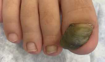Tırnak Kalınlaşması